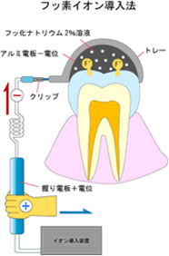 フッ素イオン導入法図解