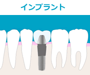 インプラントイメージ