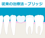 従来の治療法（１）ブリッジ