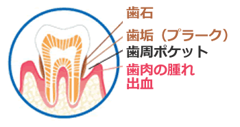 歯周病イメージ