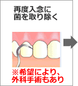 歯周病治療の流れ05