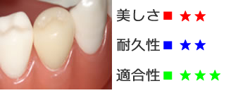 ダイレクトクラウン(臼歯部のみ)