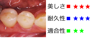 CADインレー