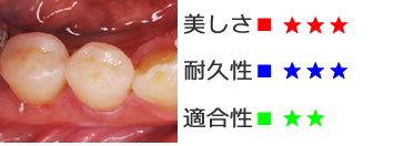 ＣＡＤインレー