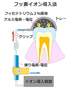 フッ素イオン導入法イメージ